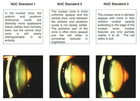 How to diagnose and grade cataracts .